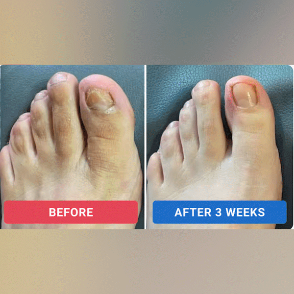 Nuvai Fungal Nail Renew Patches